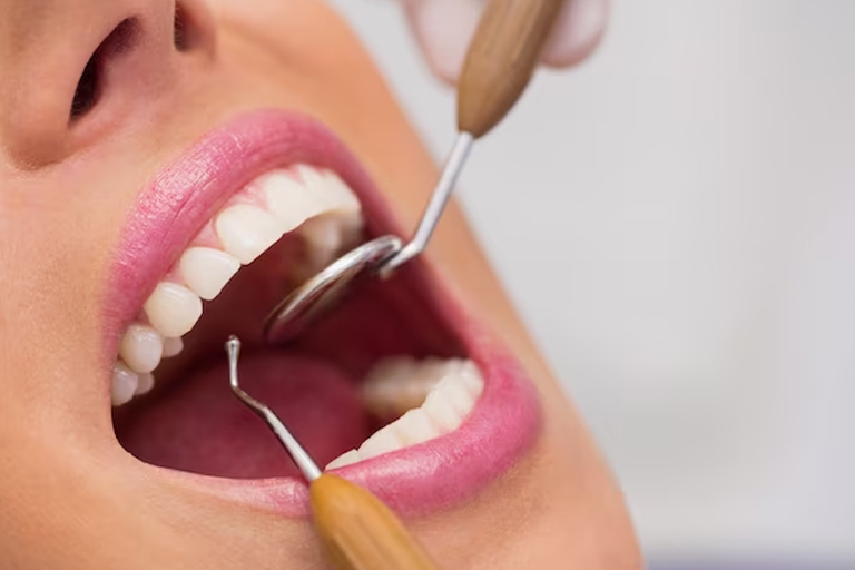 Dental Scaling and Polishing