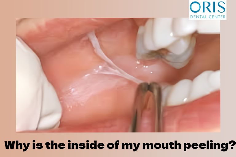 Why is the inside of my mouth peeling?